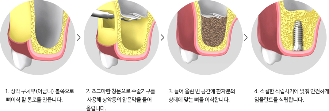 상악동거상술 시술과정