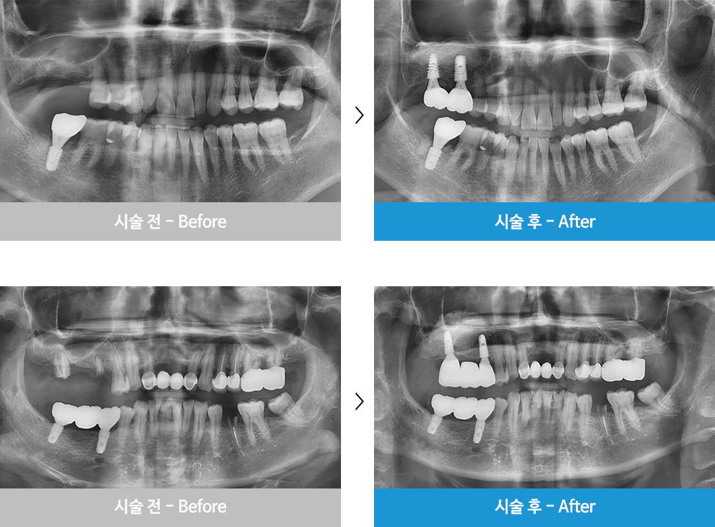 상악동거상술 X-ray 전후 사진