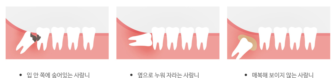 사랑니를 뽑아야 하는 이유